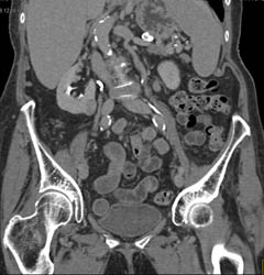 2 Cm Renal Cell Carcinoma With Multiple Phases - CTisus CT Scan