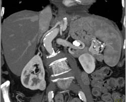 2 Cm Renal Cell Carcinoma With Multiple Phases - CTisus CT Scan