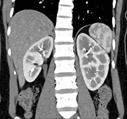 Normal Kidneys - CTisus CT Scan