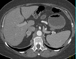 Recurrent Renal Cell Carcinoma to Contralateral Adrenal and Para-aortic Nodes - CTisus CT Scan