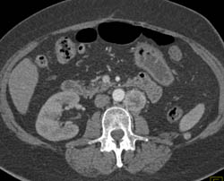 Recurrent Renal Cell Carcinoma to Contralateral Adrenal and Para-aortic Nodes - CTisus CT Scan