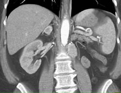 Recurrent Renal Cell Carcinoma to Contralateral Adrenal and Para-aortic Nodes - CTisus CT Scan