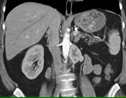 Recurrent Renal Cell Carcinoma to Contralateral Adrenal and Para-aortic Nodes - CTisus CT Scan