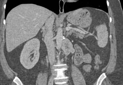 Recurrent Renal Cell Carcinoma to Contralateral Adrenal and Para-aortic Nodes - CTisus CT Scan