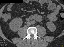 Subtle Renal Cell Carcinoma Right Kidney - CTisus CT Scan