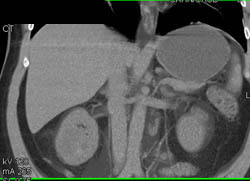 Subtle Renal Cell Carcinoma Right Kidney - CTisus CT Scan