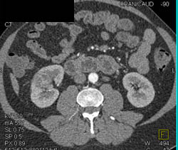 Subtle Renal Cell Carcinoma Right Kidney - CTisus CT Scan