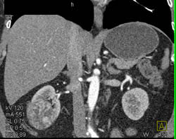 Subtle Renal Cell Carcinoma Right Kidney - CTisus CT Scan