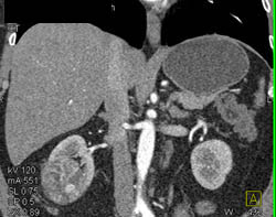 Subtle Renal Cell Carcinoma Right Kidney - CTisus CT Scan