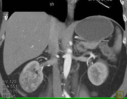 Subtle Renal Cell Carcinoma Right Kidney - CTisus CT Scan