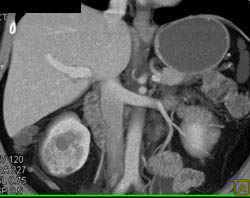 Subtle Renal Cell Carcinoma Right Kidney - CTisus CT Scan