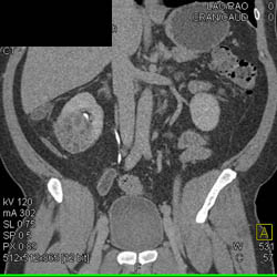 Subtle Renal Cell Carcinoma Right Kidney - CTisus CT Scan