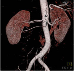 3 Right Renal Arteries in A Transplant Patient - CTisus CT Scan