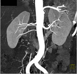 3 Right Renal Arteries in A Transplant Patient - CTisus CT Scan