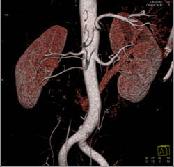 3 Right Renal Arteries in A Transplant Patient - CTisus CT Scan