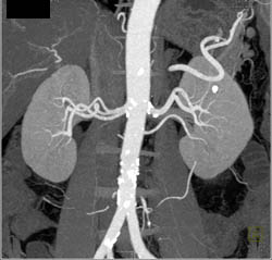 Multiple Bilateral Renal Arteries - CTisus CT Scan