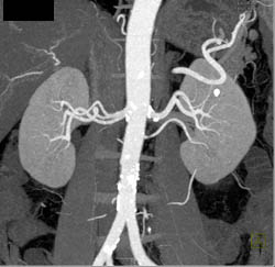 Multiple Bilateral Renal Arteries - CTisus CT Scan