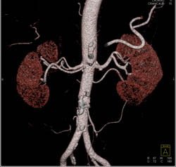 Multiple Bilateral Renal Arteries - CTisus CT Scan