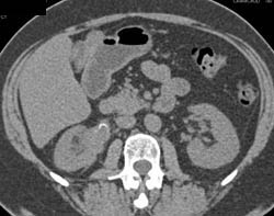 Transitional Cell Carcinoma Right Renal Pelvis in Multiple Phases - CTisus CT Scan