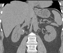 Transitional Cell Carcinoma Right Renal Pelvis in Multiple Phases - CTisus CT Scan