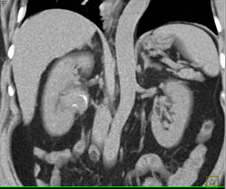 Transitional Cell Carcinoma Right Renal Pelvis in Multiple Phases - CTisus CT Scan