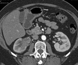 Transitional Cell Carcinoma Right Renal Pelvis in Multiple Phases - CTisus CT Scan