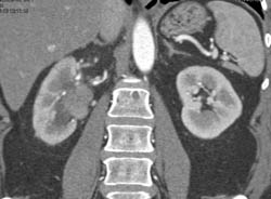 Transitional Cell Carcinoma Right Renal Pelvis in Multiple Phases - CTisus CT Scan