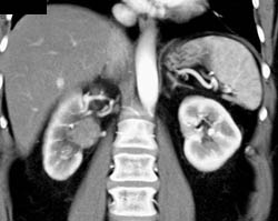 Transitional Cell Carcinoma Right Renal Pelvis in Multiple Phases - CTisus CT Scan