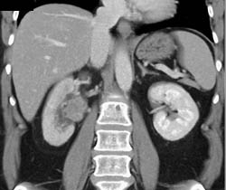 Transitional Cell Carcinoma Right Renal Pelvis in Multiple Phases - CTisus CT Scan