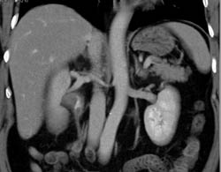 Transitional Cell Carcinoma Right Renal Pelvis in Multiple Phases - CTisus CT Scan