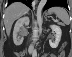 Transitional Cell Carcinoma Right Renal Pelvis in Multiple Phases - CTisus CT Scan