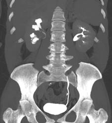 Transitional Cell Carcinoma Right Renal Pelvis in Multiple Phases - CTisus CT Scan