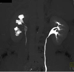 Transitional Cell Carcinoma Right Renal Pelvis in Multiple Phases - CTisus CT Scan