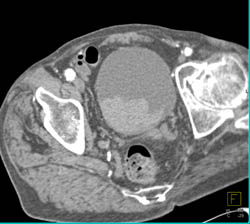 Active Bleed in Bladder Cancer- See Sequence - CTisus CT Scan