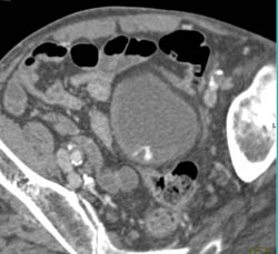 Active Bleed in Bladder Cancer- See Sequence - CTisus CT Scan