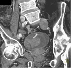 Active Bleed in Bladder Cancer- See Sequence - CTisus CT Scan