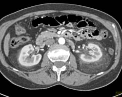 Stranding Around Both Kidneys in Peri and Para-renal Spaces Like ErdheimChester Disease - CTisus CT Scan