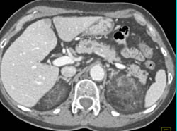 Stranding Around Both Kidneys in Peri and Para-renal Spaces Like ErdheimChester Disease - CTisus CT Scan