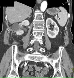 Complex Cystic Changes S/p Radiofrequency Ablation (RFA) - See Sequence - CTisus CT Scan