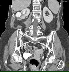 Complex Cystic Changes S/p Radiofrequency Ablation (RFA) - See Sequence - CTisus CT Scan