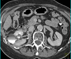 Complex Cystic Changes S/p Radiofrequency Ablation (RFA) - See Sequence - CTisus CT Scan