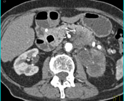 Transitional Cell Carcinoma With Nodes and Infiltration of the Kidney. the Renal Artery Is Encased - CTisus CT Scan