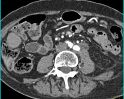 Transitional Cell Carcinoma With Nodes and Infiltration of the Kidney. the Renal Artery Is Encased - CTisus CT Scan