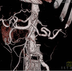 Transitional Cell Carcinoma With Nodes and Infiltration of the Kidney. the Renal Artery Is Encased - CTisus CT Scan