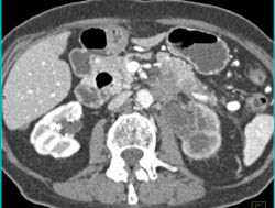 Transitional Cell Carcinoma With Nodes and Infiltration of the Kidney. the Renal Artery Is Encased - CTisus CT Scan