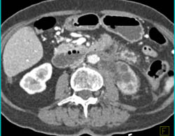 Transitional Cell Carcinoma With Nodes and Infiltration of the Kidney. the Renal Artery Is Encased - CTisus CT Scan