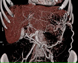 the Renal Tumor Encases the Splenic Vein and Collaterals Are Seen - CTisus CT Scan