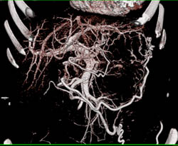 the Renal Tumor Encases the Splenic Vein and Collaterals Are Seen - CTisus CT Scan