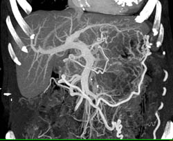 the Renal Tumor Encases the Splenic Vein and Collaterals Are Seen - CTisus CT Scan