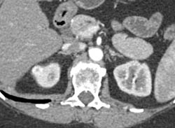 1 Cm Right Renal Cell Carcinoma- See Full Sequence - CTisus CT Scan